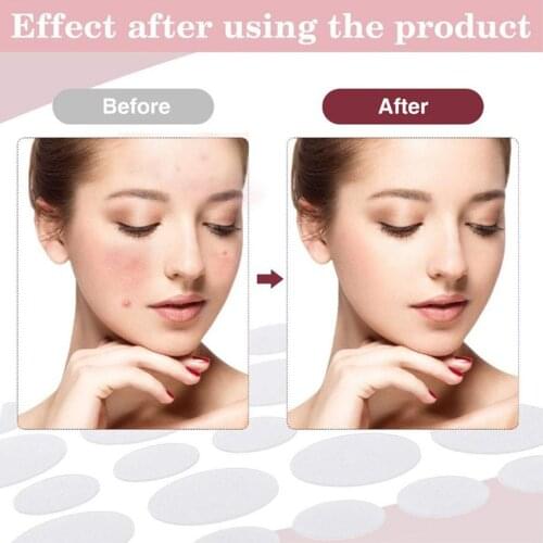 Acne Spot Patch Hydrocolloid Invisible Absorbing Patch Acne Pimple Master Patches Face Spot Stickers Face Care Tool