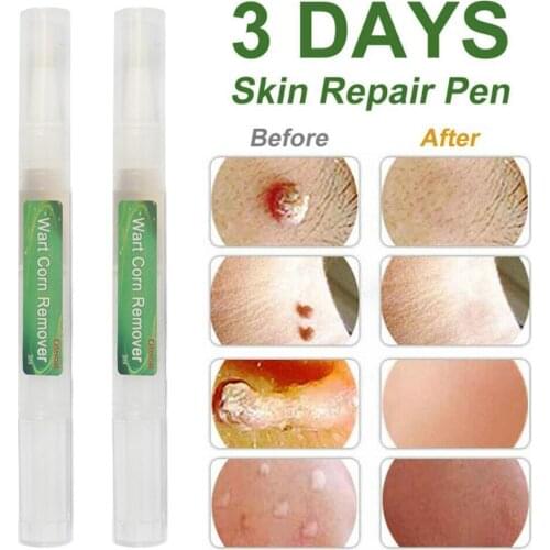 Genital External Wart Corn Remover 3ml Treatment Papillomas Removing Warts Removal Moles
