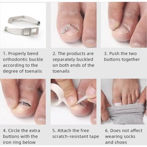 1 Pair New Toe Nail Fixer Toenail Correction Treatment Pedicure Embed Tool Recover Foot Care Lifter C3R4