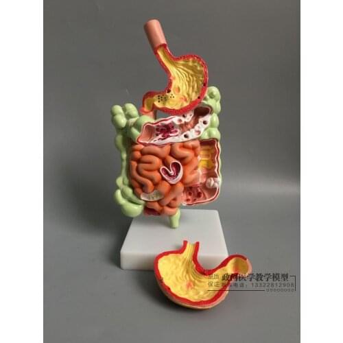 Human gastrointestinal pathology model digestive tract gastric coronal section transverse colon gastrointestinal anatomy model