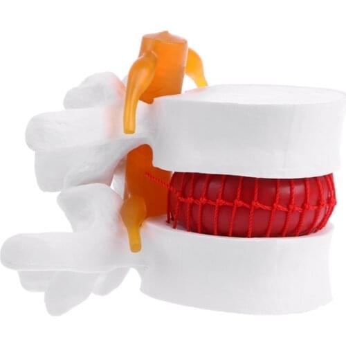 Human Anatomical Lumbar Disc Herniation Model Learn Aid Anatomy Instrume