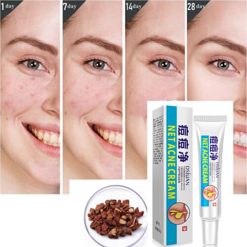 Herbal Effective Acne Remover Cream Natural Plant Acne Treatment Fade Acne Spots Acne Cream Oil Control Shrink Pores Skin Care
