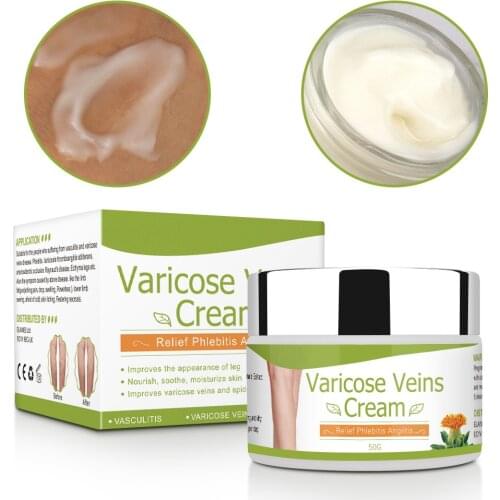 Varicose Veins Cream Natural Treatment Cream For Varicose and Spider Veins Chinese Herbal Medicine Remove Spider Veins