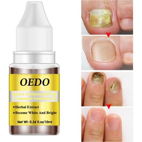 Fungal Nail Repair Essence Anti Fungus Treatment Serum Nails Gel Remove Onychomycosis Paronychia Anti Infection Nails Care