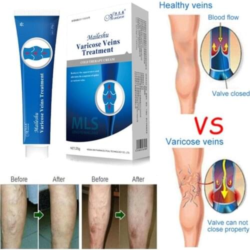 Varicose Veins Treatment Cream Effective cure Vasculitis Phlebitis Spider Veins Pain Varicosity Angiitis ointment Health Care