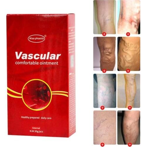 Varicose Veins Treatment Cream Ointment Vasculitis Angiitis Cream Pain Veins Varicosity Herbal Phlebitis Removal Q Spider R Y8R1