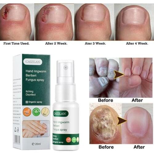 New 20ml Foot Anti Fungus Essence Serum Remove Onychomycosis Repair Treatment Liquid Health Nail Care Repair Liquid Solution