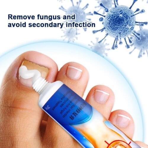 Nail Fungus Removal Cream, Nail Care Ointment, Anti-Infection, For Toenails, 1Pcs. K7H4