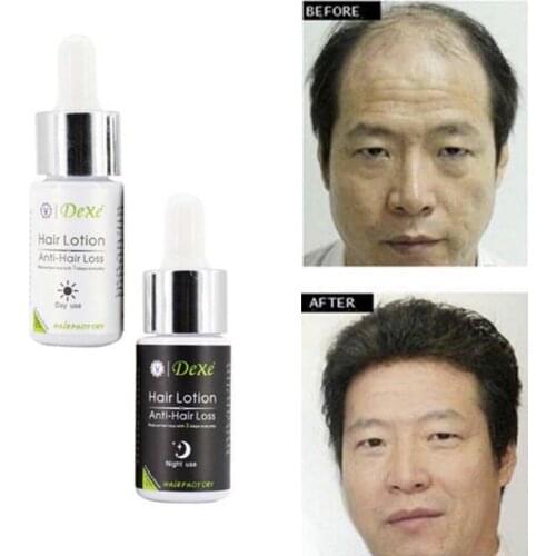 DEXE Potent Hair loss product fast hair growth grow serum Restoration Yuda pilatory stop effective regrowth liquid beard oil