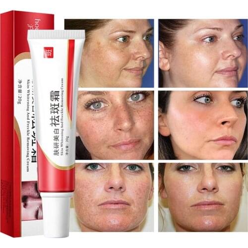 Effective Whitening Freckle Cream Remove Melasma Acne Spot Pigment Melanin Dark Spots Pigmentation Moisturizing Gel Skin Care