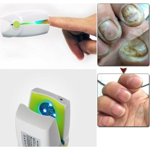 905nm Cold Fungal Nail Treatment Laser Nail Fungal Onychomycosis Paronychia Anti-Fungal Lnfection Grey Toenail Laser Device