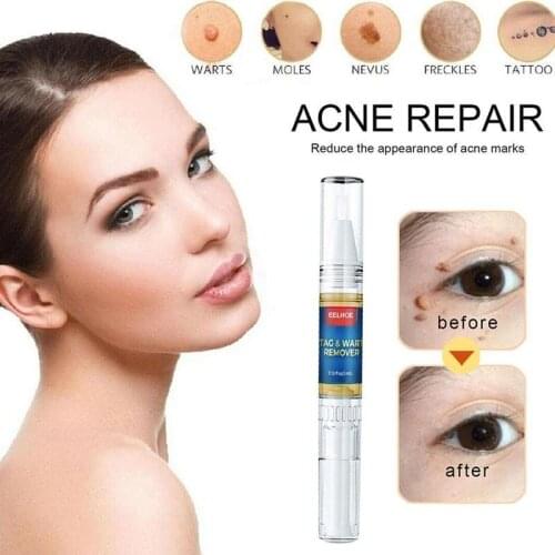11g Skin Tag Remover Skin Tags Genital Wart Remover Foot Care Cream Treatment Foot Corn Removal Blackhead Remover Liquid