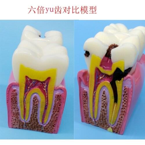 Oral 6X Enlarge Human Teeth Model Human Teeth Anatomy Model Human Caries Model Medical Teaching Aids Dentist Teaching Equipment