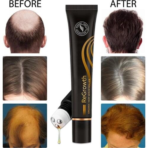 JCSYFAC Hair Loss Remedies