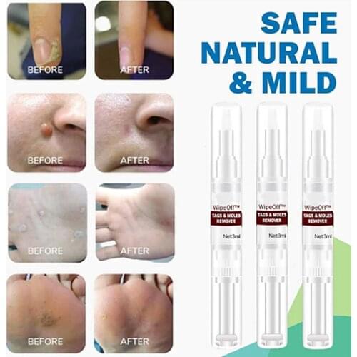 Genital Wart Treatment Papillomas Removal of Warts Liquid From Skin Tags Removing Against Moles Remover Wart Removal 3ML