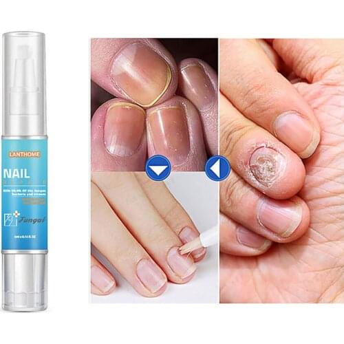 4ml Nail Pen Care Repair Liquid Anti Fungal Antioxidant Remove Onychomycosis Toe Nourishing Brighten Soften Hand Foot Nail Care