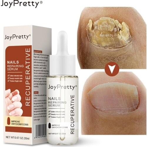 Nail Fungal Treatment Feet Care Essence Anti Infection Paronychia Onychomycosis Nail Foot Brighten Toe Nail Fungus Removal Gel