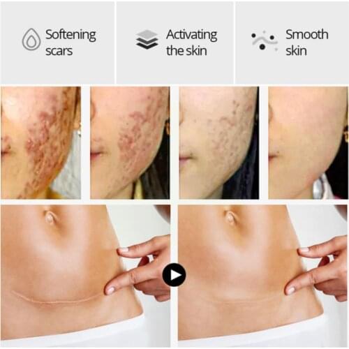 Fish Peptide Protein Scar Repair Essence Acne Remove Whiten Balance Skin Tone Care Korean Moisturize Stretch Mark Face Serum