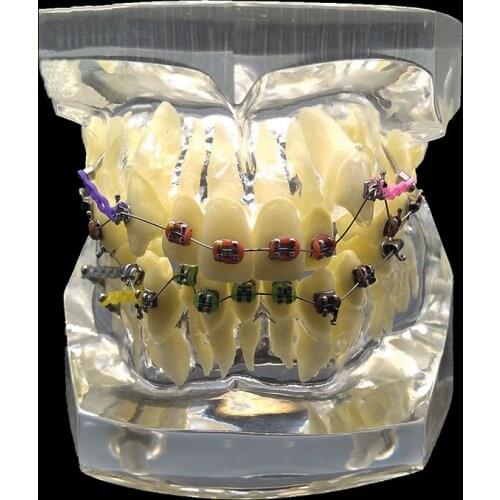 Dental Orthodontic Model Transparent Malocclusion Correction Display Models with Bracket Ligature Wire Dental Teeth Model