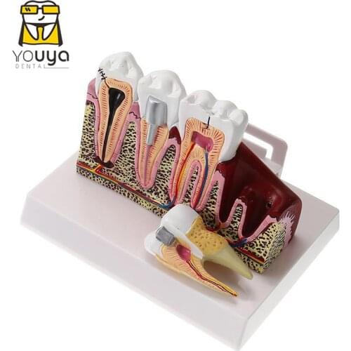 Standard Dental Oral Teeth Anatomical Teaching Model Comprehensive Tooth Structure Model Dentist Dental Student Demonstration