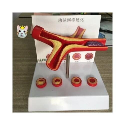 Human atherosclerosis Cardiovascular model blood vessel Thrombosis model Human vascular model
