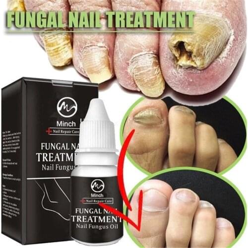 Minch Fungal Nail Treatment Serum Onychomycosis Paronychia Anti-Fungal Nail Infection Herbal Toe Fungus Foot Repair Essence Care