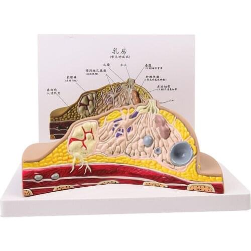 Gynecological breast anatomical model Common breast diseases Breast pathological anatomy Breast structure model