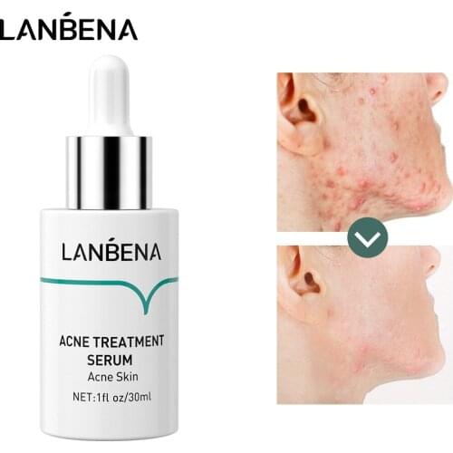 LANBENA Acne Serum Hyaluronic Oilgopeptide Anti-Acne Treatment Remove Acne Scar Spot Marks Shrink Pores Whitening Skin Care 30ml