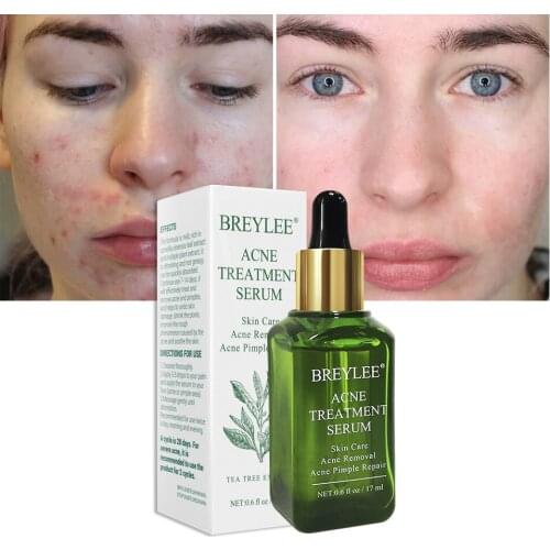 Acne Treatment Serum Face Facial Essence Anti Acne Scar Removal Cream Skin Care Whitening Repair Pimple Remover For Acne