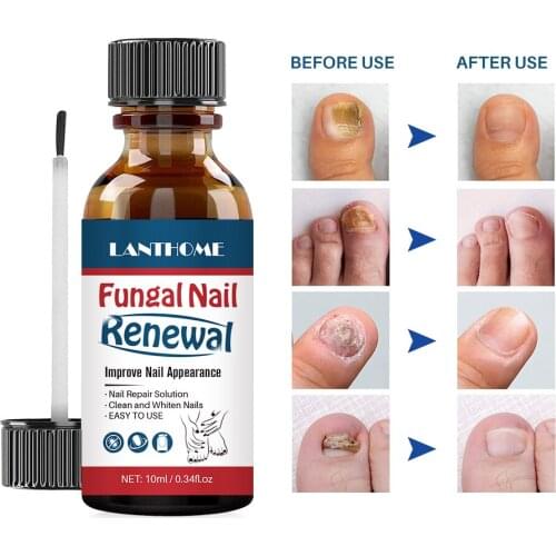 LANTHOME Fungal Nail Repair Essence Serum Toe Nail Fungus Treatment Nails Gel Anti Infection Paronychia Onychomycosis Nails Care
