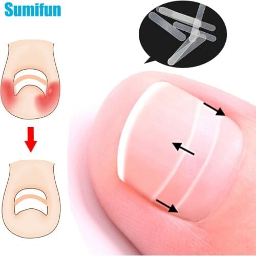 20pcs Toe Nail Ingrown Correction Foot Sticker Foot Care Paronychia File Elastic Patch Corrector Treatment Pedicure D1352