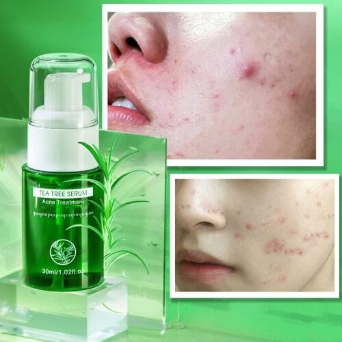 Tea Tree Acne Treatment Face Serum Essence Acne Acne Mark Closed Mouth And Repair Cream 30ML Skin Care Tools Blackhead Remover