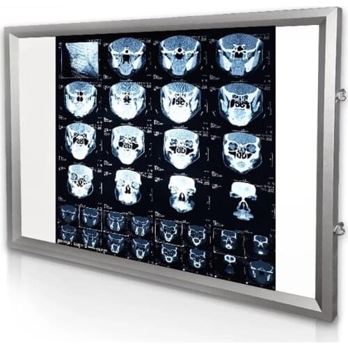 AC 100-240V Hospital X-ray Viewing Lamp Dental Orthopaedic Manual Control X-Ray Film Illuminator Light Box X-ray Viewer
