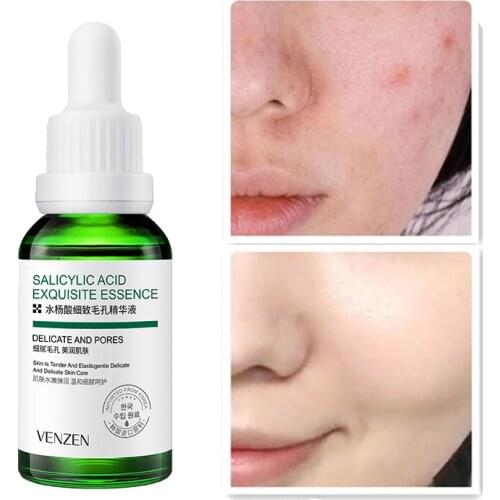 Aloe Salicylic Acid Acne Treatment Serum Oil Control Shrink Pores Face Essence Hyaluronic Acid Moisturizing Brighten Skin Toner