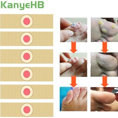 24pcs Foot Care Medical Plaster Foot Corn Removal Calluses Plantar Warts Thorn Ointment Plaster Health Care For Relieving Pain