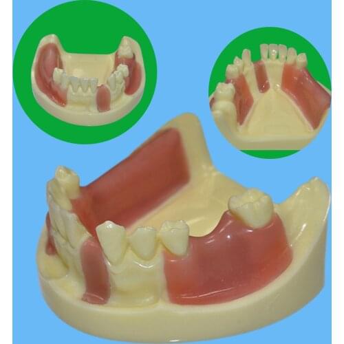 1 Piece Dental Implant Practice Teeth Model with Imitation Bone (Drilling) & Silicone Soft Gum (Cutting/Stitching)