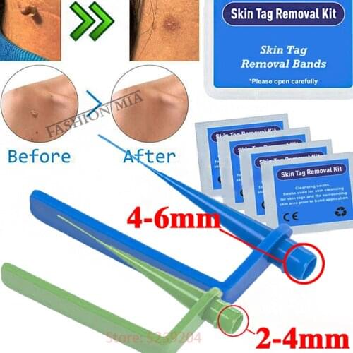 Micro Skin Tag Removal band Mole Wart Remover kit skin tag patch Micro Cone Set for Small to Medium Skin Tags Remover Treatment