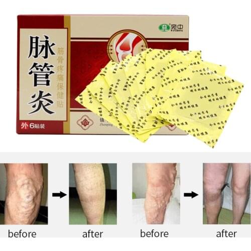 24PCS Chinese Traditional herbal medicine Patches Cure Spider Veins Varicose Treatment Plaster Varicose Veins Vasculitis Natural
