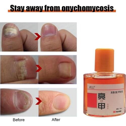25ML Bright nail health care solution to treat onychomycosis boutique concentrated external use to protect nail health