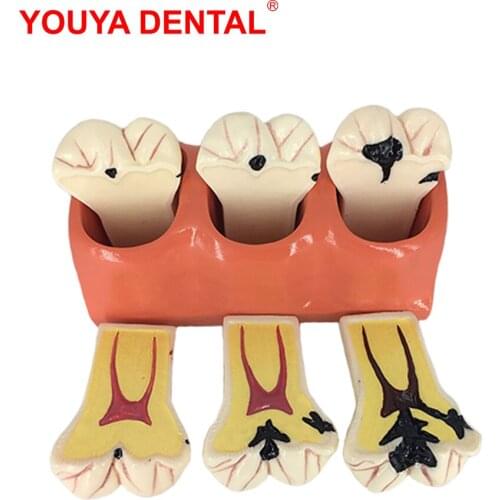 Dental Model Teeth Modeling 4times Caries Developing Teaching Model For Studying Medical Science Oral Dentist Dentistry Products