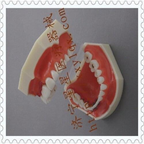 Patient communication Dental teaching model 12.6cm*7.8cm*6.2cm Periodontal Disease model Oral model free shipping