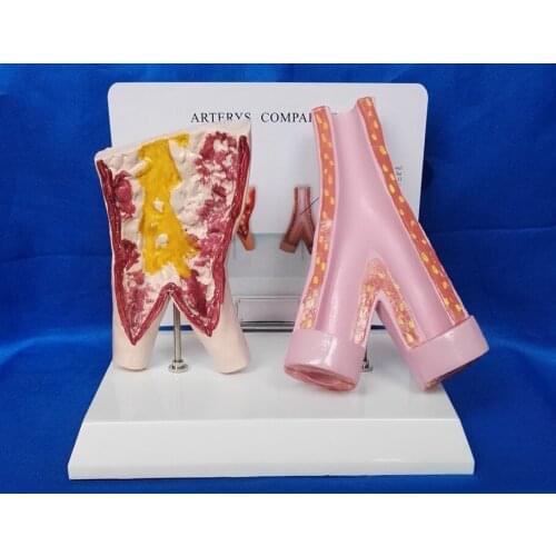 Arterys Comparison Smoking Vessels and Normal Vessels Model Human Vascular Medical Teaching Model