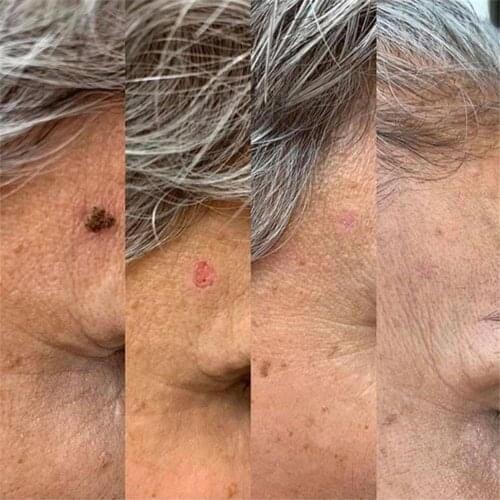 10ml Hot Sales Skin Remover Liquid Wart Removal Freckle Wart Tag Care Spot Skin Wart Remover Dark Freckle Body F1X5