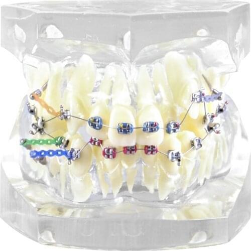 Dental Typodont Teeth Model Demonstrate Treatment/Dental Study Model with Bracket and Ligature Wire/Orthodontic Model M3005-3
