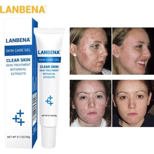 LANBENA 20g Acne Treatment Gel Acne Cleaning Cream Blackhead Remover Acne Spots Face Acne Scars Skin Care Repair Comedone Pimple