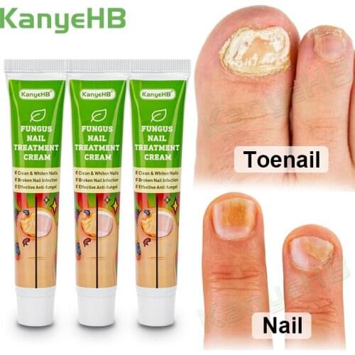 3pcs Fungal Nail Treatment Cream Feet Nail Care Essence Cream Toe Fungus Removal Ointment Paronychia Onychomycosis Cream A653