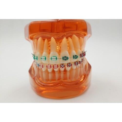 Good Quality Teeth model With metal & ceramic brackets Irregular tooth Ortho Metal dentist patient student learning model