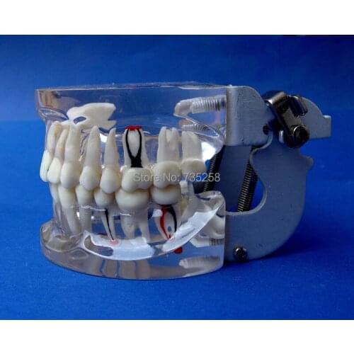 Adult teeth Pathology Model,Oral Pathology Model,Teeth Lesion Teaching Model