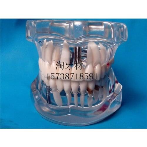 Dental Materials removable dental teeth model pathological tooth model Crystal Dental teeth Dental Materials