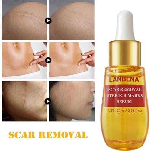 Acne Scar Removal Face Serum Acne Spots Pigmentation Corrector Anti Scar Stretch Marks Repairing Smoothing Skin Care Essence
